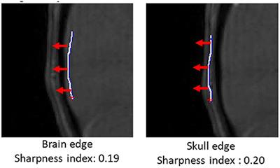 Quantitative Assessment of the Intracranial Vasculature of Infants and Adults Using iCafe (Intracranial Artery Feature Extraction)